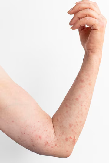 Inverse psoriasis: Causes, symptoms, and more
