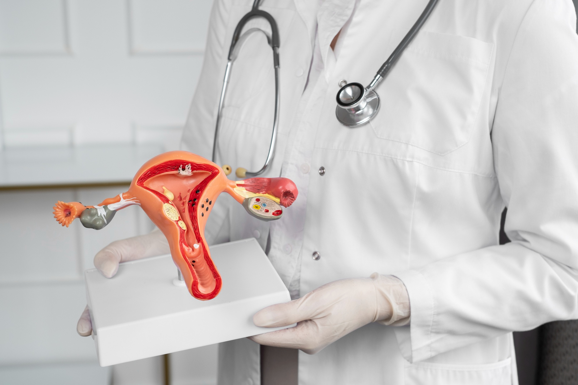 Ovarian Cysts - symptoms and treatment