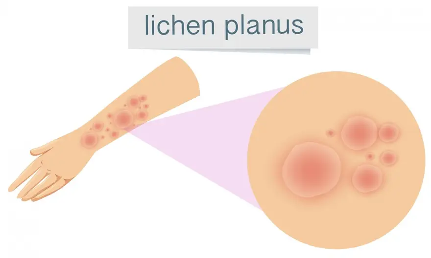 Lichen Sclerosus: Symptoms, Causes, and Treatment